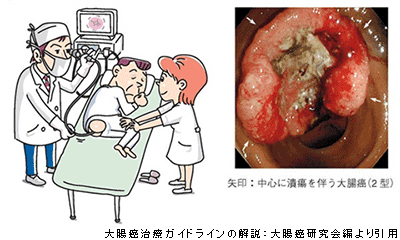 大腸がんの写真