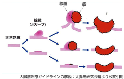 大腸ポリープから大腸がんが生じる経過画像
