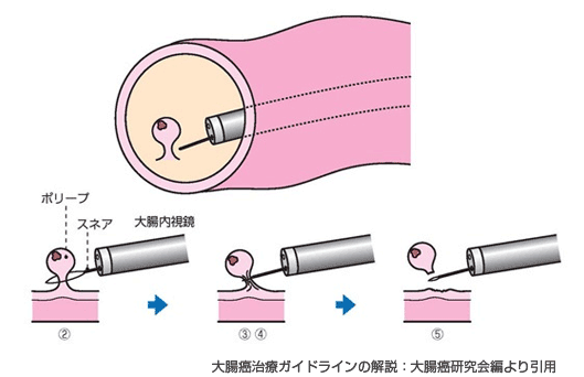 内視鏡による大腸ポリープの切除イラスト（ポリペクトミー）